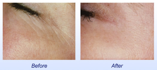 PhotoFacial Before & After 2