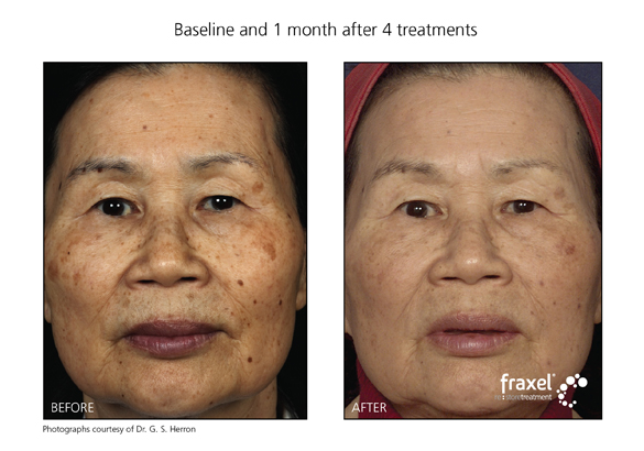 Fraxel Before & After 2