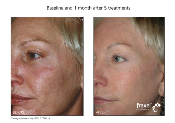 Fraxel Before & After 5